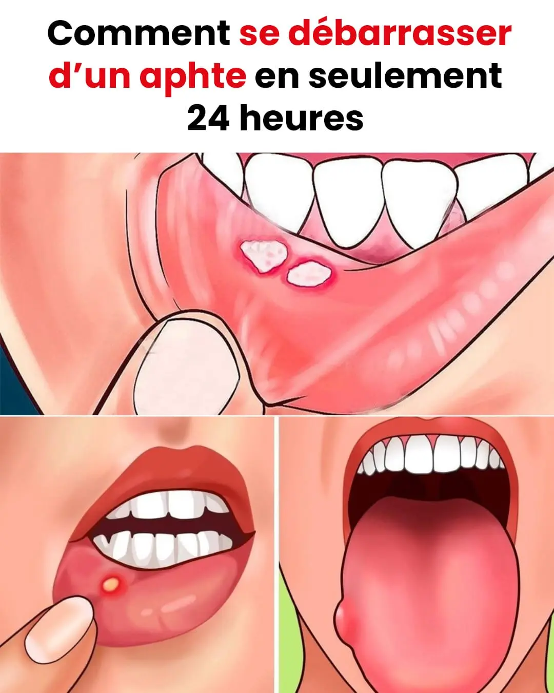 Comment eliminer un aphte en seulement 24 heures.jpg