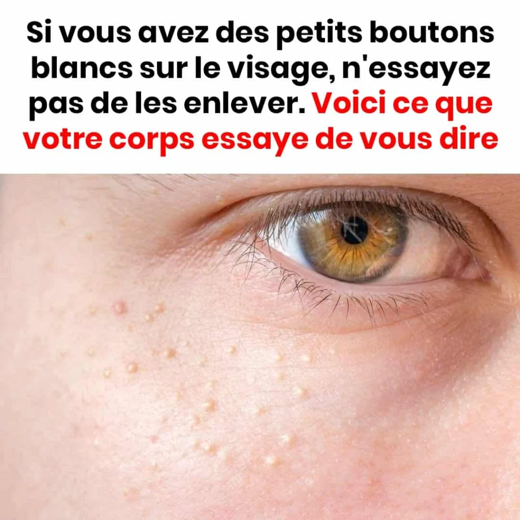 Si vous remarquez de petites protuberances blanches sur votre visage evitez de les retirer par vous meme 1024x1024.jpg