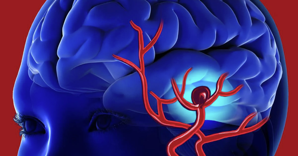 Anevrisme reconnaissez les symptomes critiques quil ne faut surtout pas ignorer