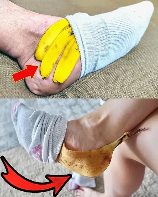 Peau de banane sur vos pieds un remede naturel surprenant.jpg