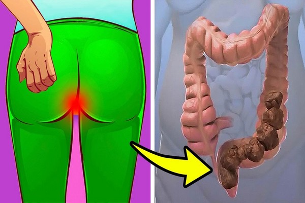 Constipation – Cause Remede Soulagement Guerison et Traitement