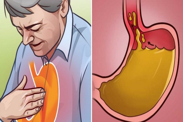 Les Remedes Naturels Pour Apaiser Le Reflux Acide De Lestomac