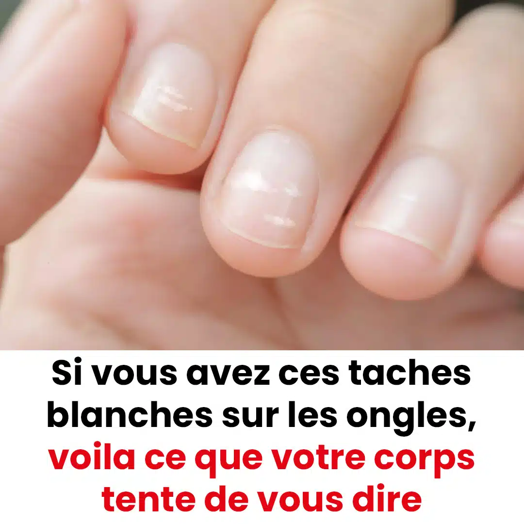 Pourquoi observe t on parfois des taches blanches sur les ongles.jpg