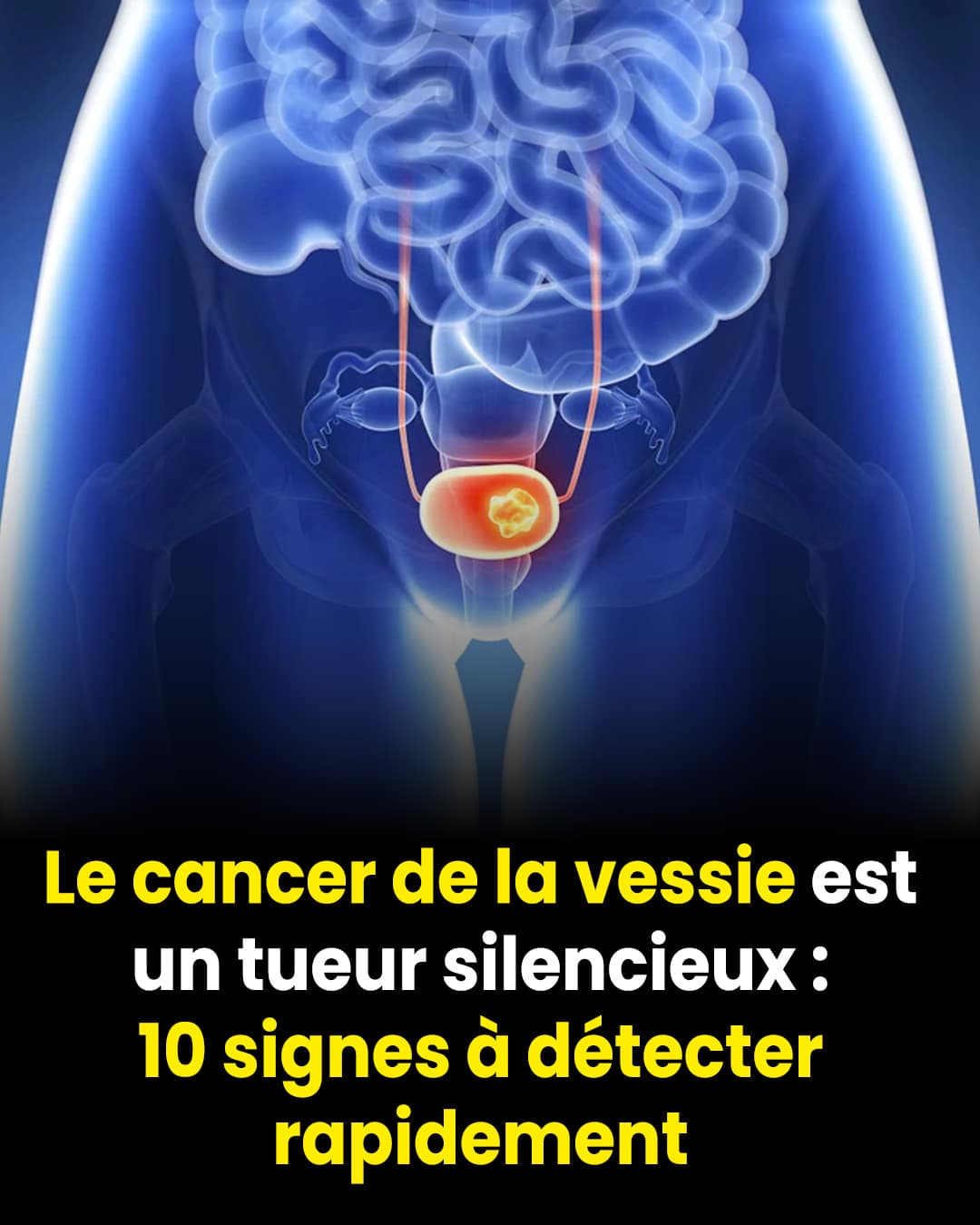 Le cancer de la vessie est un tueur silencieux 10 signes a detecter rapidement