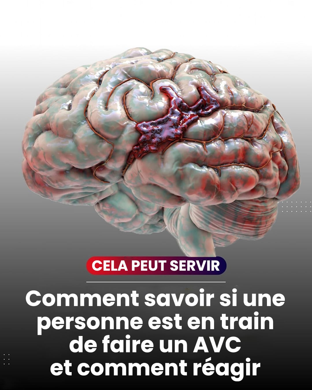 Comment reconnaitre un accident vasculaire cerebral avc