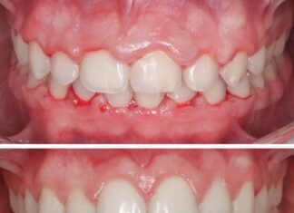 Gingevectomia antes y despues 324x235